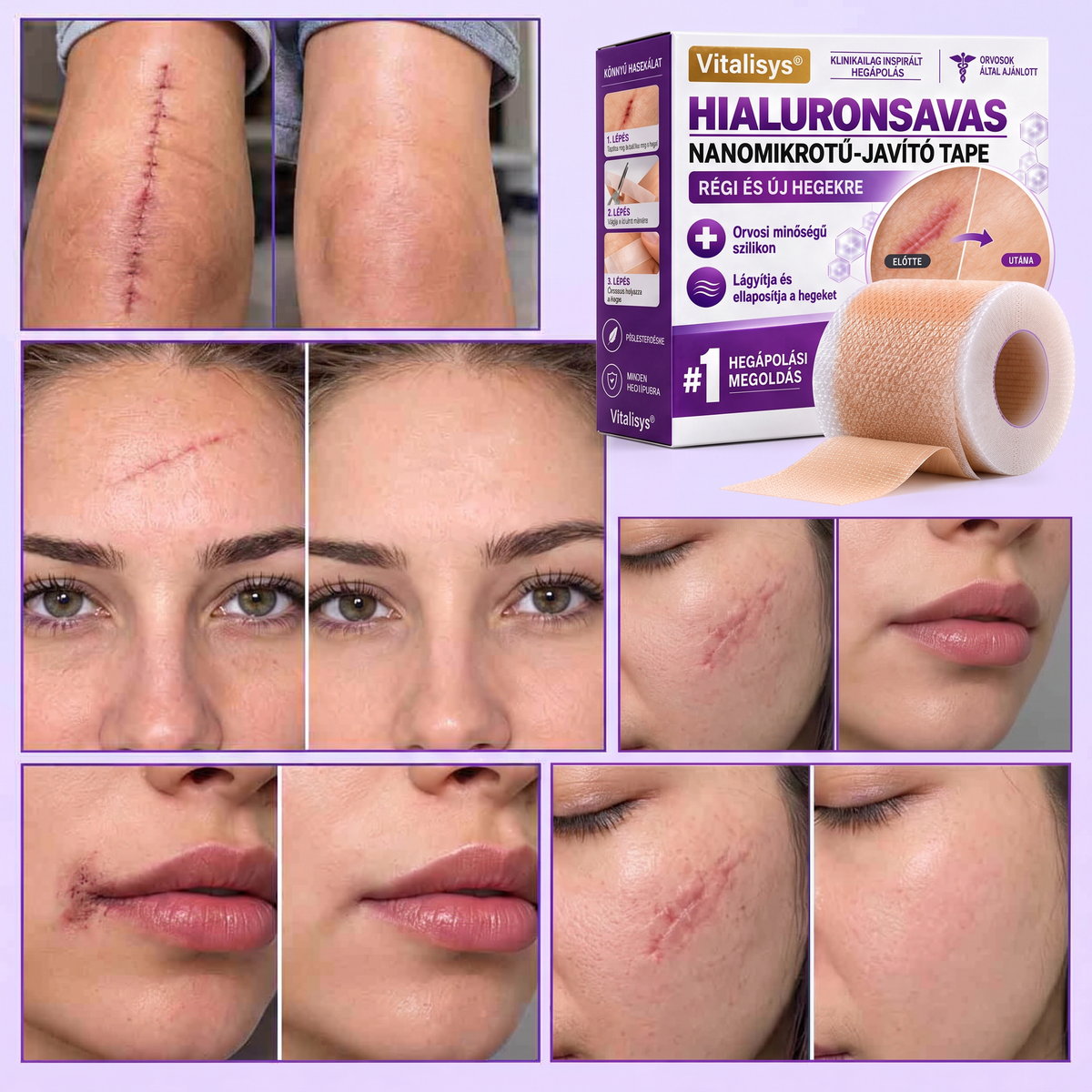 Vitalisys® Hyaluronsavas Nanomikrotű-hegjavító Tapasz🍇